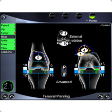 Final Planning in Knee replacement Surgery