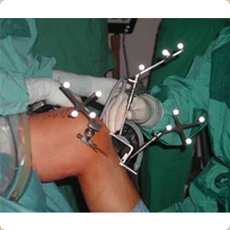 CAS for Arthroscopic ACL Reconstruction