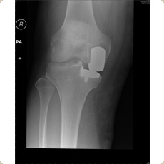 Unicondylar Knee Replacement