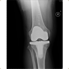 Total Knee replacement