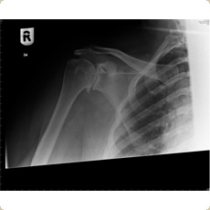 Copeland Shoulder Resurfacing