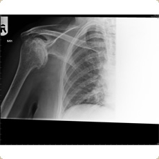 Cemented Shoulder Hemiarthroplasty