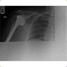 Cemented Shoulder Hemiarthroplasty