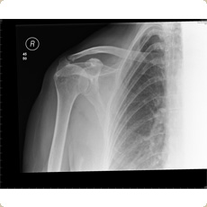 Reverse Total Shoulder Replacement