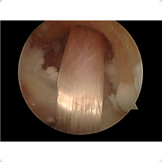 Arthroscopic View of Hamstring ACL Graft