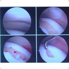 Microfracture procedure