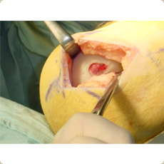 Microfracture procedure