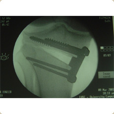 Microfracture procedure