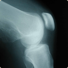 Acromio-clavicular joint instability