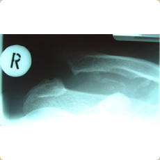 Acromio-clavicular joint instability