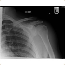 Copeland Shoulder Resurfacing