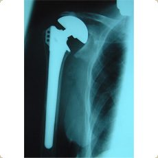 Bipolar Hemiarthroplasty for cuff arthropathy