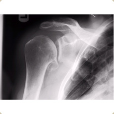 Gleno-humeral arthritis