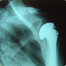 Gleno-humeral arthritis