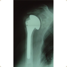 Gleno-humeral arthritis